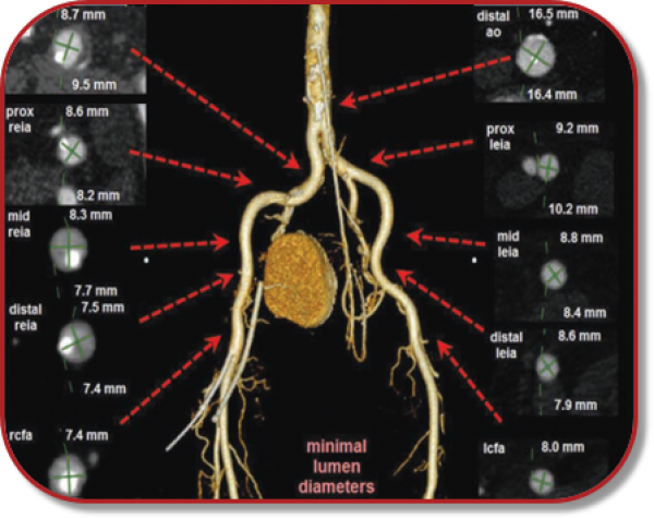ct protocol tavi